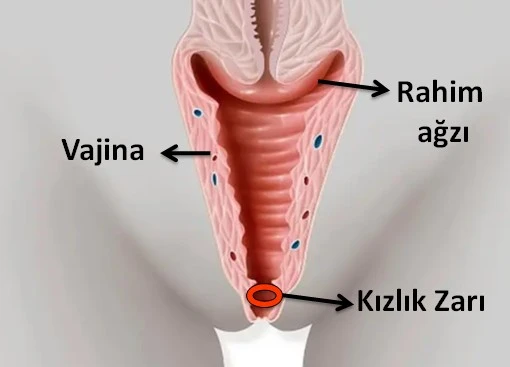Kızlık Zarı Nedir?