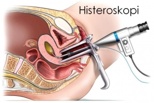 Histeroskopi