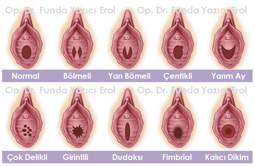 Kızlık Zarı Dikimi