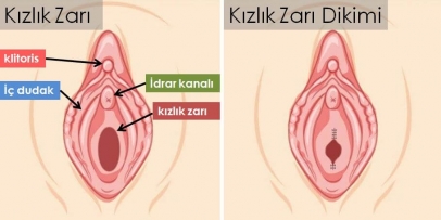 Kızlık Zarı Dikimi