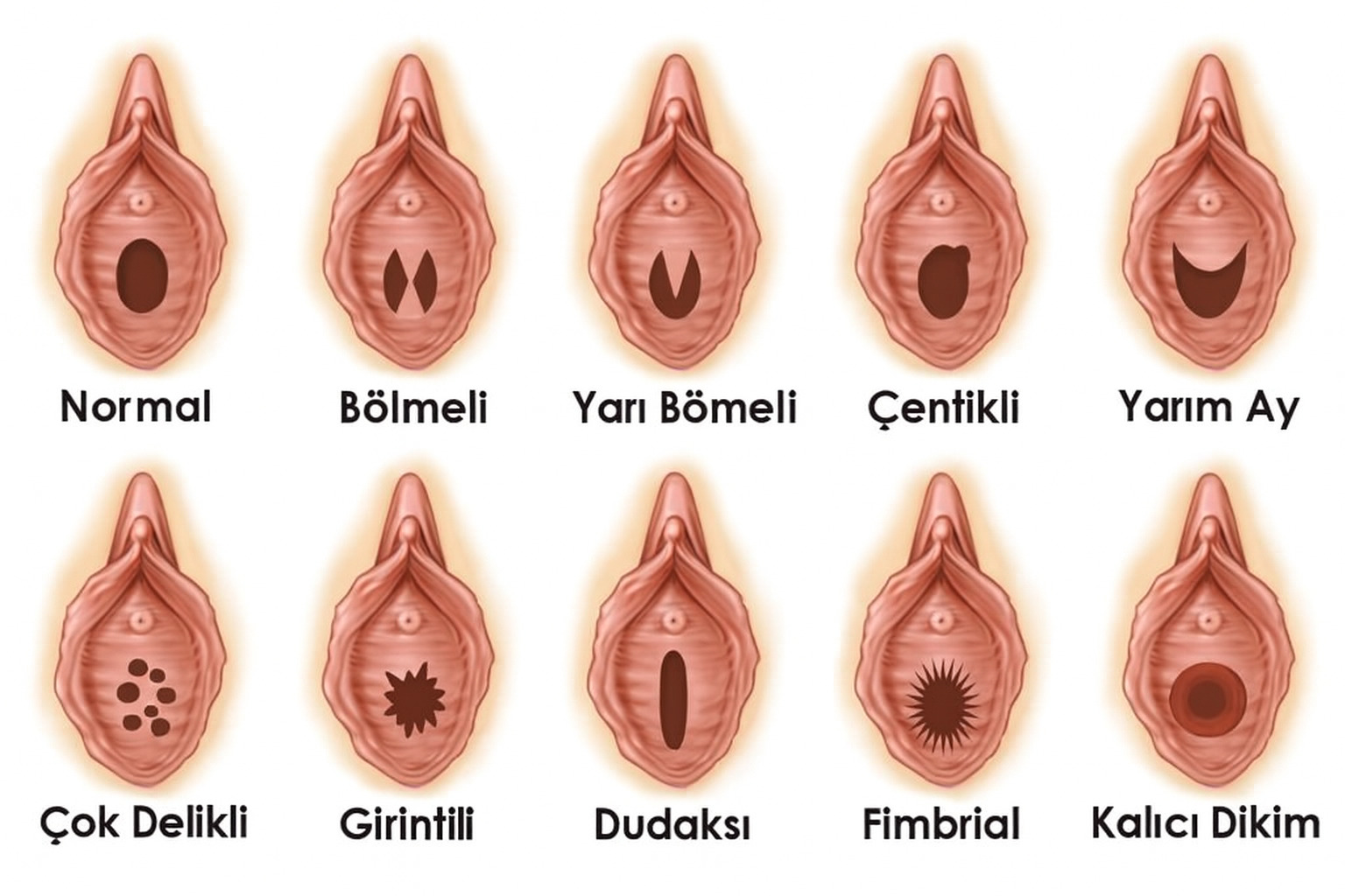Kızlık Zarı Çeşitleri, Tipleri, Şekilleri