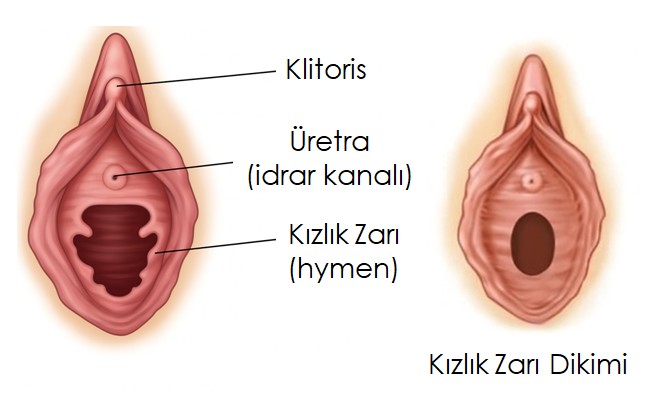 Kızlık Zarı Dikimi