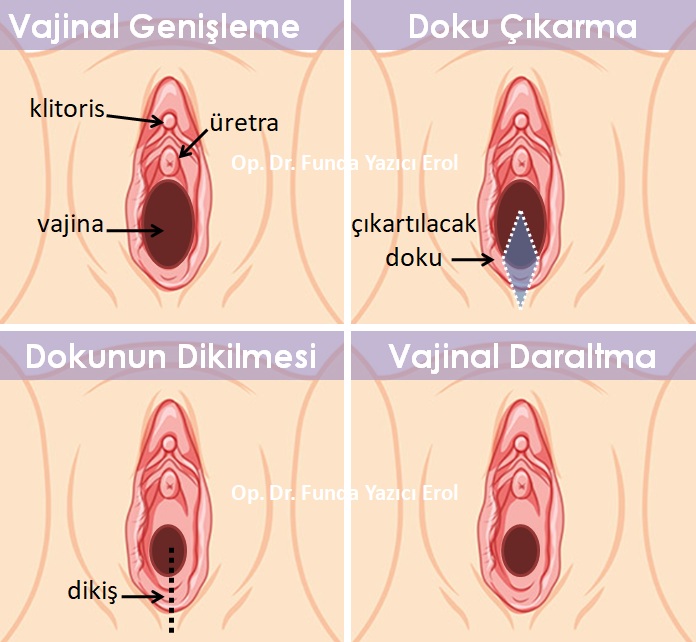 Vajina Daraltma Fiyatları