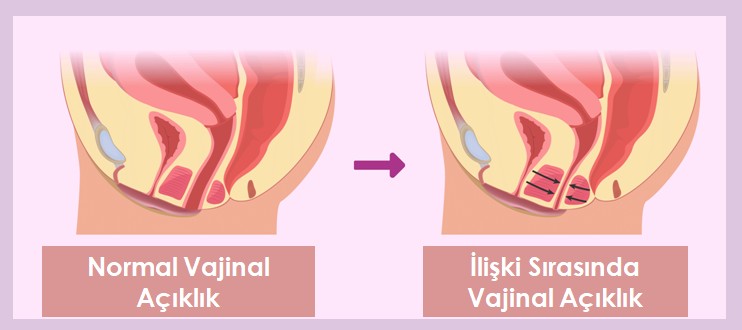 Vajinismus Tedavisi