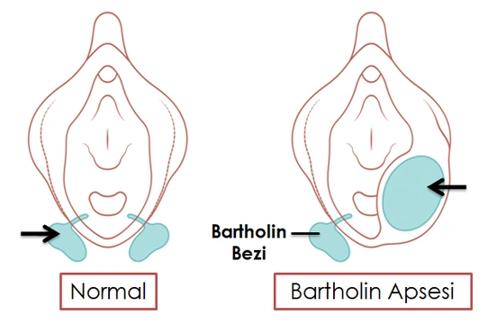 Bartholin Apsesi Neden Olur?