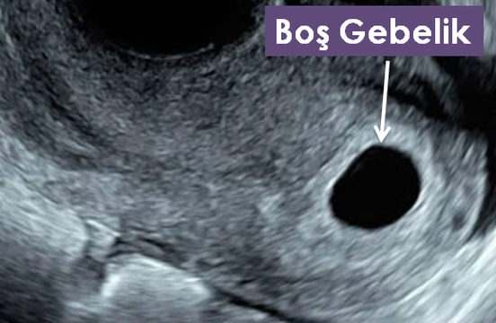 Boş Gebelik Nedir?