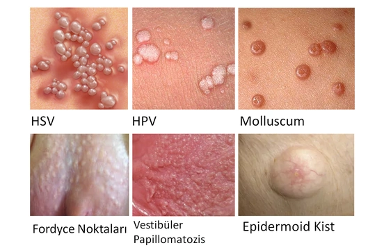 Genital Bölgede Kabarcık Neden Olur?