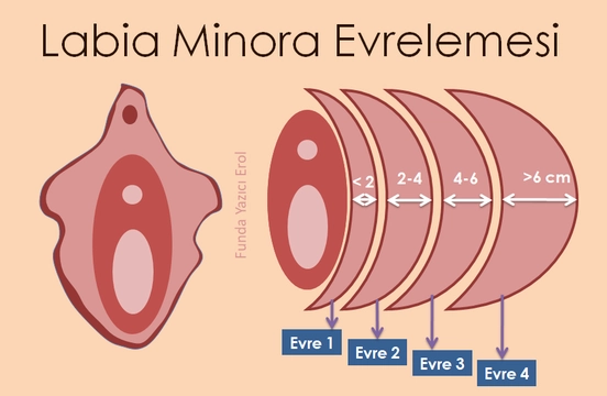 Labioplasti Ameliyatı Öncesi Labia Minora Evrelemesi