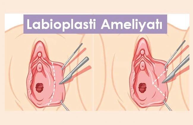 Labioplasti Fiyatı 2025