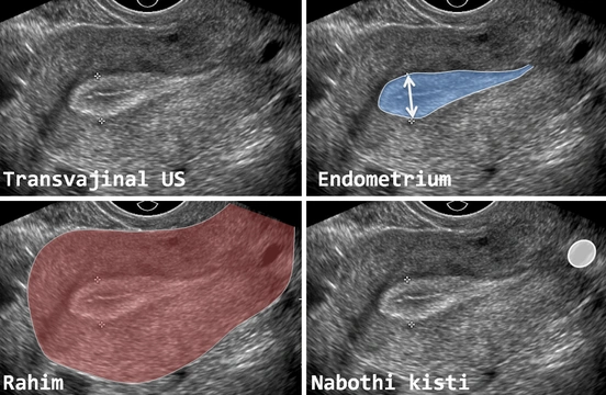 Rahim Zarı (Endometrium) Kalınlaşması
