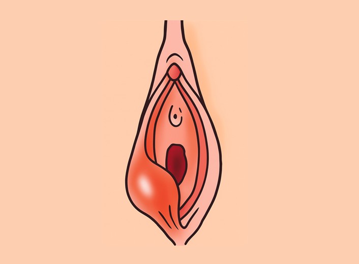 Bartholin Kisti