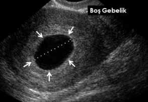 Boş Gebelik Kürtajı