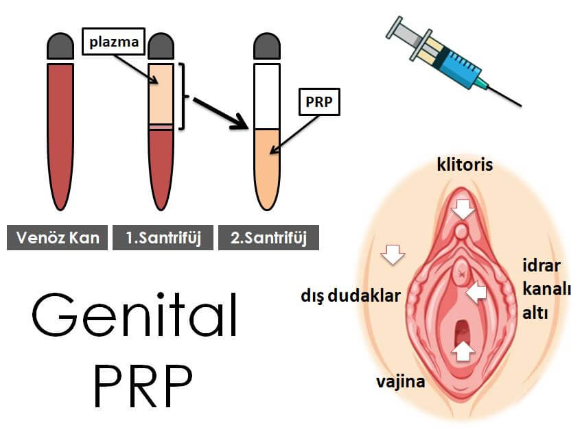 Genital PRP Tedavisi