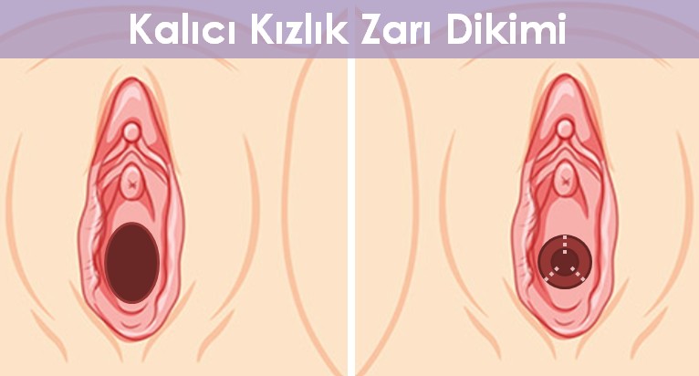 Kalıcı Kızlık Zarı Dikimi Sonrası
