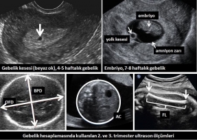 Gebelik Hesaplama Ultrason CRL BPD AC FL