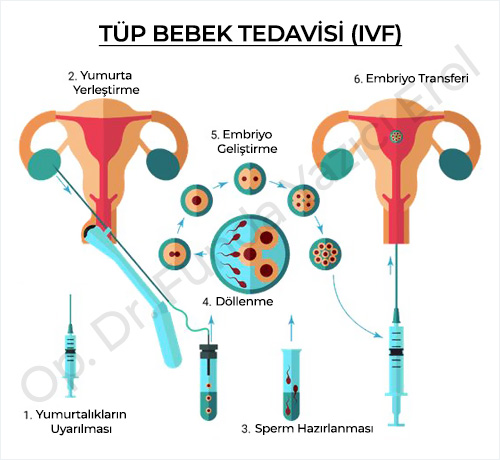Tüp Bebek Tedavisi (IVF)