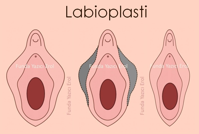 Labioplasti Yaptıranlar